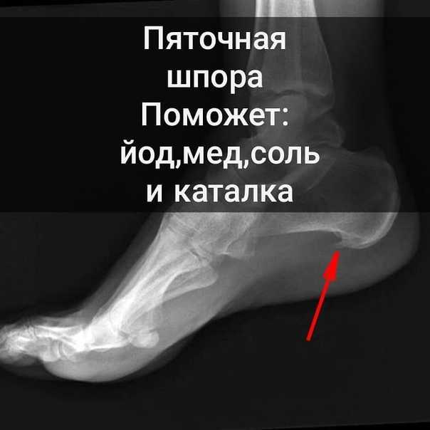 Симптомы сифилиса (фото), лечение и последствия