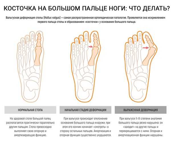 К чему снятся пальцы на ногах 👣 — подробные толкования ❗ по 26 разным сонникам: что означает для мужчины или женщины видеть во сне большой или много лишних пальчиков